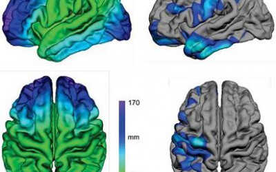 Conexiones neuronales: demostrada su relación con el Autismo