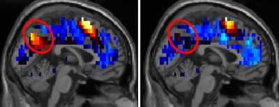 Nuevos hallazgos sobre el funcionamiento del cerebro de las personas con Autismo